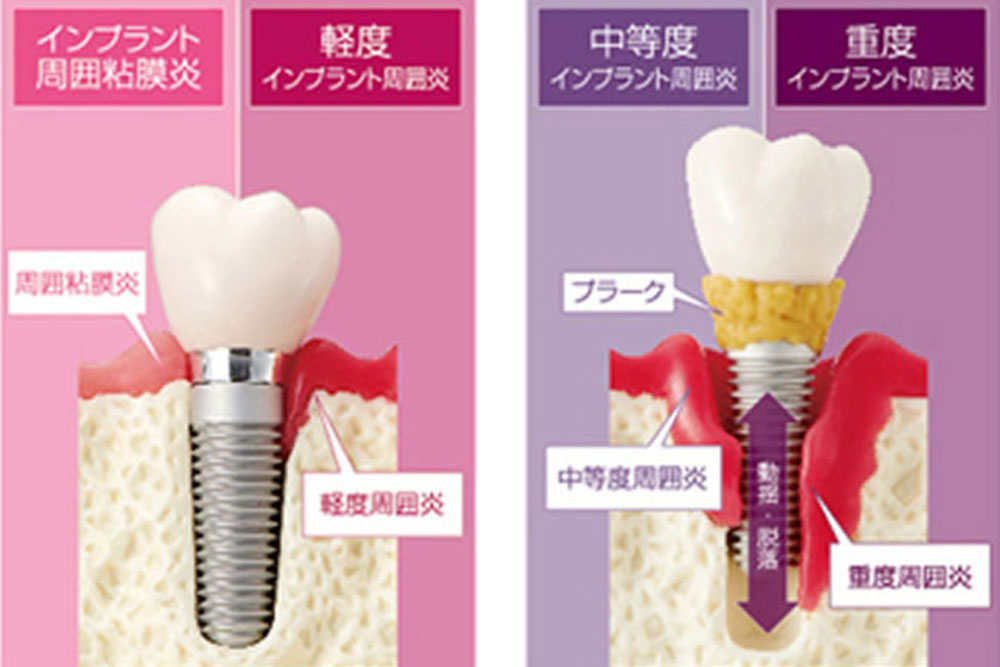 インプラント周囲炎