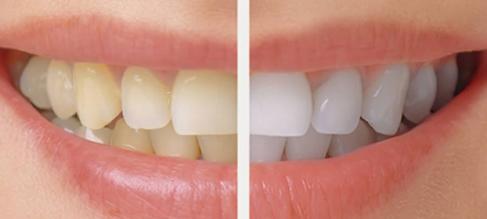 輝く白い歯